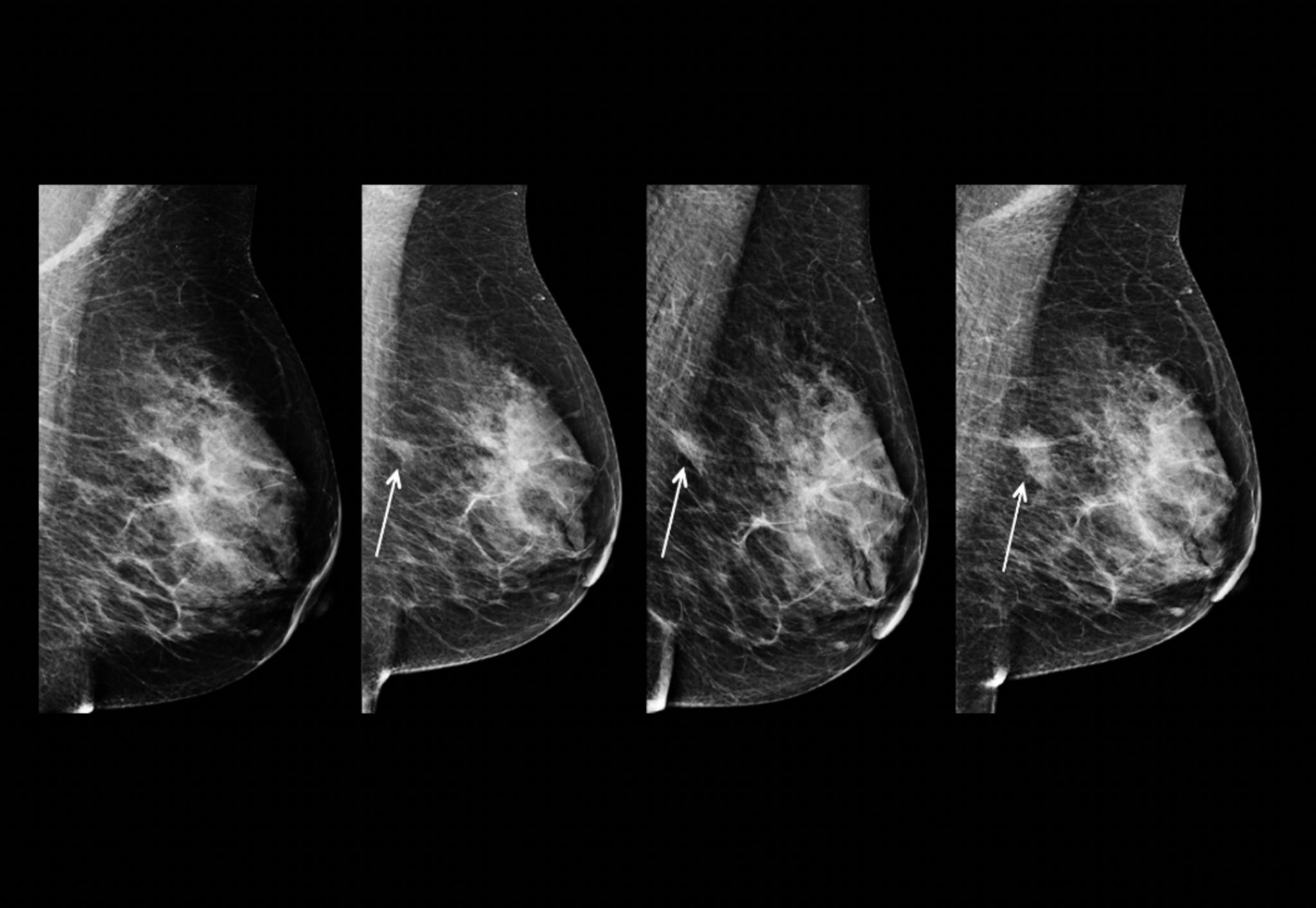 AI Innovations in Early Breast Cancer Detection - NHSJS