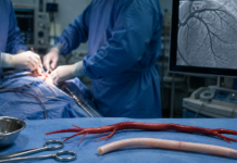 Optimal Graft Selection in CABG: Comparative Outcomes of Radial-Artery and Saphenous Vein Grafts